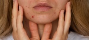 Unrecognizable person showing acne on face. Close-up acne on face with rash 